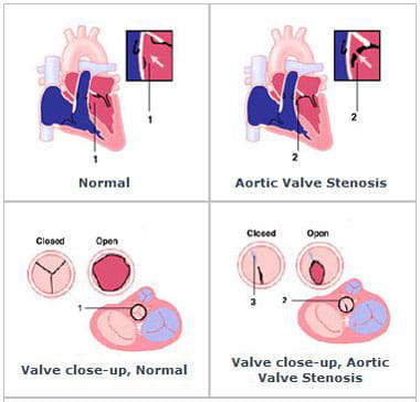 An illustration of aortic stenosis.